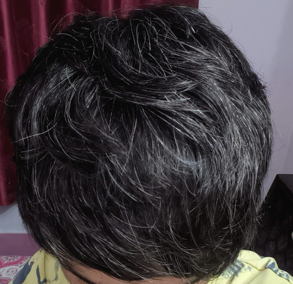 Premature Graying of Hair